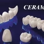 Vì sao nên bọc răng sứ Ceramill? Giá răng sứ Ceramill bao nhiêu tiền?