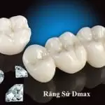 Răng sứ Dmax: Nguồn gốc, xuất xứ và các trường hợp nên bọc