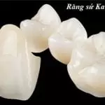 Bọc răng sứ Katana có tốt không? Giá bao nhiêu và quy trình bọc