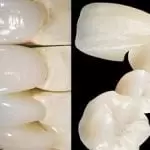 So sánh răng sứ Katana và Venus: Nên chọn bọc răng nào?