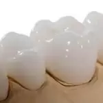 Bọc răng sứ Venus và những điều bạn cần biết trước khi bọc