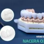 Răng toàn sứ Nacera Q3 là gì? Ưu điểm và khi nào nên bọc?