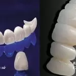 So sánh răng sứ Zirconia và Cercon: Nên chọn loại răng nào?
