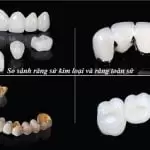 So sánh răng sứ kim loại và răng toàn sứ nên bọc loại răng nào?