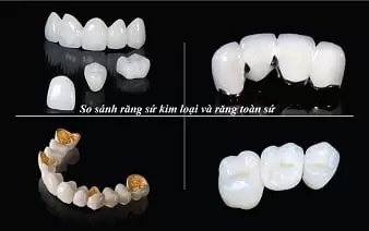 so-sanh-rang-su-kim-loai-rang-toan-su