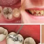 Trám răng thẩm mỹ là gì? Lợi ích, quy trình và khi nào nên trám?