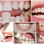 Bọc sứ răng cửa các trường hợp nên bọc? Chọn loại nào tốt nhất?