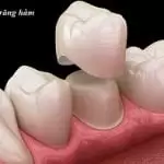 Bọc sứ răng hàm: Ai nên bọc? Chọn loại răng nào? Quy trình ra sao?