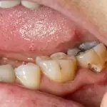 Bọc sứ răng sâu khi nào nên bọc? Những điều phải biết trước làm