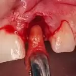 Nhổ răng người lớn khi nào cần nhổ? Quy trình và lưu ý khi nhổ răng