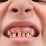 Nhổ răng trẻ em nên tự nhổ hay đến nha khoa? Các lưu ý sau khi nhổ