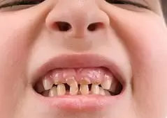 nho-rang-tre-em-nha-khoa