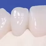 Răng sứ Emax có mấy loại? Ưu điểm là gì? Giá bọc bao nhiêu 1 răng?