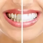 Tẩy trắng răng Laser Zoom II: Hiện đại, hiệu quả nhanh nhất hiện nay