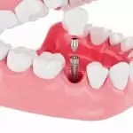 Trồng răng implant giá bao nhiêu? Cần lưu ý gì sau khi thực hiện?