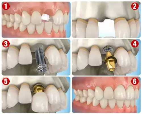 trồng răng implant