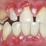 Viêm nha chu là gì? Nguyên nhân, triệu chứng và phương pháp điều trị