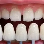 Bọc răng sứ không mài là gì? Giá bao nhiêu? Tuổi thọ bao lâu?