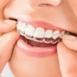 Yếu tố nào tác động đến giá niềng răng trong suốt Invisalign?