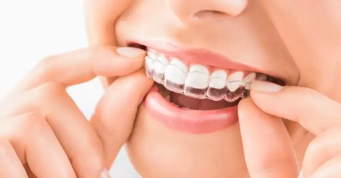 nieng-rang-trong-suot-Invisalign
