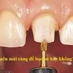 Có nên mài răng để bọc sứ hay không? Có đau không?