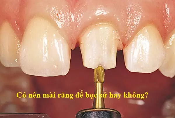 co-nen-mai-rang-de-boc-su