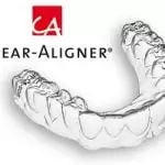 Lý do niềng răng trong suốt Clear Aligner được nhiều người lựa chọn