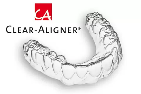 ly-do-chon-nieng-rang-trong-suot-clear-aliger