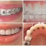 Nên niềng răng mắc cài sứ hay mắc cài kim loại?