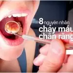 Chảy máu chân răng là gì? Nguyên nhân và cách điều trị dứt điểm