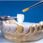 Mặt dán sứ Veneer: Ưu điểm và quy trình thực hiện chuẩn nha khoa