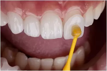 nen-boc-su-hay-dan-su1