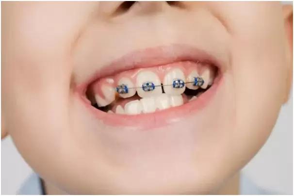 nieng-rang-cho-tre-em
