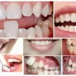 Phục hình răng sứ CAD/CAM – Công nghệ nha khoa thẩm mỹ hiện đại