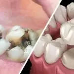 Tìm hiểu về quy trình bọc răng sứ cho răng sâu chuẩn nha khoa