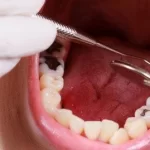 Bọc sứ răng cấm là gì? Khi nào nên bọc sứ răng cấm?