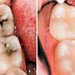 Những thông tin bổ ích về bọc sứ răng hàm mà bạn phải biết