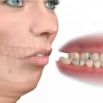 Bọc sứ răng hô là gì? Tìm hiểu thông tin thú vị về bọc sứ răng hô