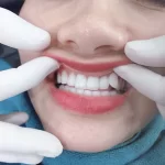 Bọc sứ răng khểnh có thực sự tốt? Quy trình bọc sứ răng khểnh chuẩn nha khoa