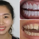 Nên bọc sứ răng thưa hay niềng răng? Bọc sứ răng thưa dùng được bao lâu?