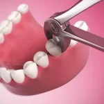 Nhổ răng xong bị đau nhức thì làm thế nào? Nguyên nhân và cách giảm đau nhanh