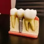 Câu trả lời cho câu hỏi “Cắm implant có đau không” những gì bạn cần biết