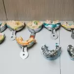 Khám phá những nhược điểm của phương pháp trồng răng implant