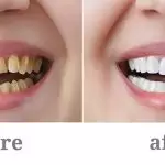 Bọc răng sứ đúng kỹ thuật – Bền vững hay không?