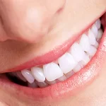 Biến chứng sau khi bọc răng sứ: Các nguyên nhân và cách phòng ngừa hiệu quả