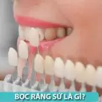 Bọc răng sứ: Thời gian sử dụng và tần suất đổi mới bao lâu?