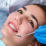 18 tuổi – Niềng răng có khả năng hay vấn đề cần lưu ý?