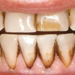 Răng bị đen bề mặt: Nguyên nhân và cách làm trắng nhanh nhất