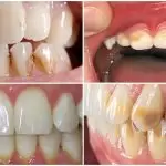 Bọc răng sứ: Câu trả lời chi tiết về đau đớn mà bạn cần biết