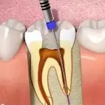 Lấy tuỷ răng có đau không? Khi nào bạn cần phải lấy tuỷ?